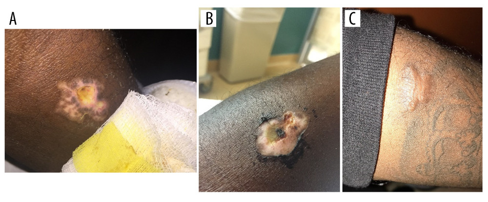(A, B) Loxosceles bite site on patient’s left forearm with fat necrosis prior to discharge and (C) site 6 months after bite. Photographs taken with patient and parent permission.