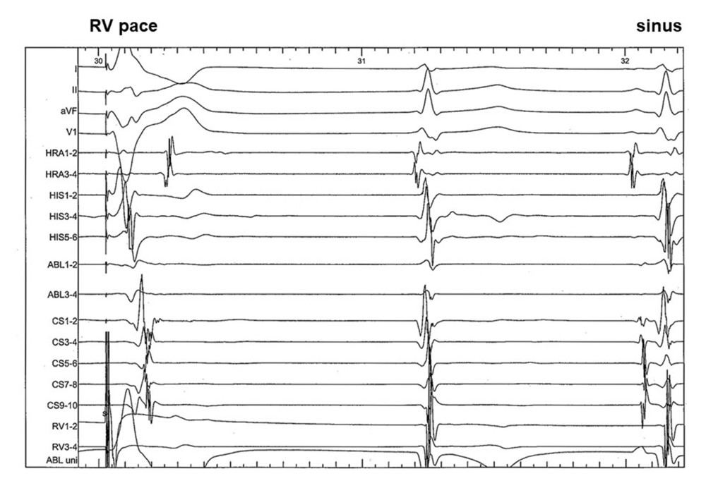 Antegrade accessory pathway conduction was abolished in Case 1 by radiofrequency energy, while preserving the retrograde accessory pathway conduction.