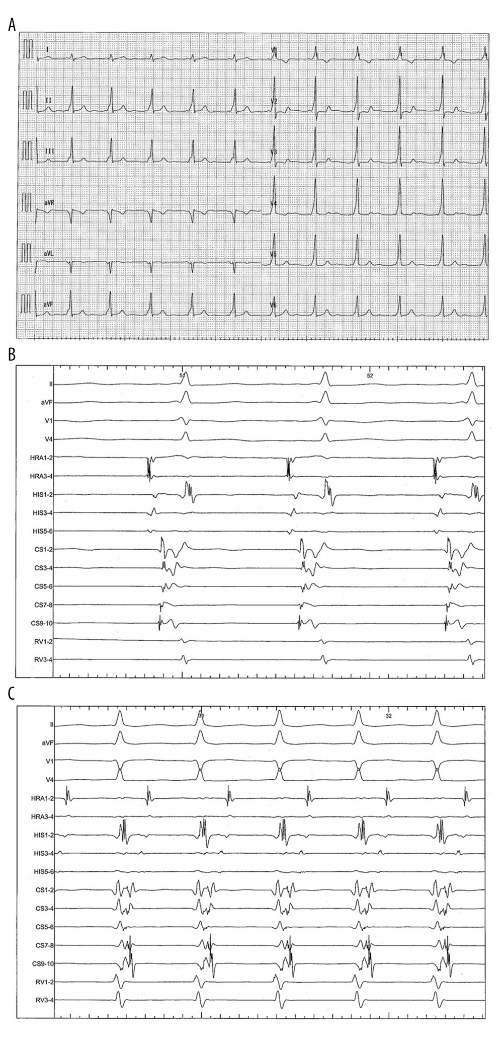 Type A Wolff-Parkinson-White (WPW) syndrome in Case 2. (A) Twelve-lead surface electrocardiogram (ECG) findings consistent with type A WPW syndrome. (B) Mapping of intracardiac potentials revealed that the site of earliest activation was adjacent to the lateral mitral annulus in an accessory pathway with antegrade conduction. (C) Atrioventricular reciprocating tachycardia was easily induced by programmed stimulation. HRA – high right atrium; CS – coronary sinus (1–2 distal; 9–10 proximal); paper speed 100 mm/s.