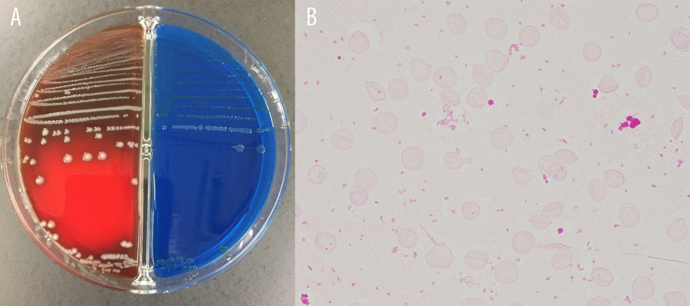 (A) The red medium is trypticase soy agar II sheep blood agar, and the blue medium is bromothymol blue lactose agar. The bacterial cells produced indole, and β-hemolysis was observed. Since there was no H2S production in Salmonella-Shigella agar medium, the bacterium was considered to be Edwardsiella of biogroup 1 rather than wild type. (B) The bacterium was a gram-negative short rod bacterium typical of Edwardsiella tarda and showed an Enterobacteriaceae-like morphology.