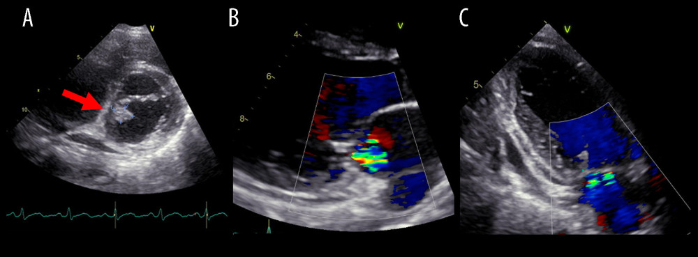 Transthoracic echocardiography. (A) A mass (13×10 mm) was attached to the posterior commissure of the mitral valve with high mobility. Arrow shows the vegetation. Mild-to-moderate mitral regurgitation was detected. (B) Parasternal long-axis view. (C) Two-chamber view.