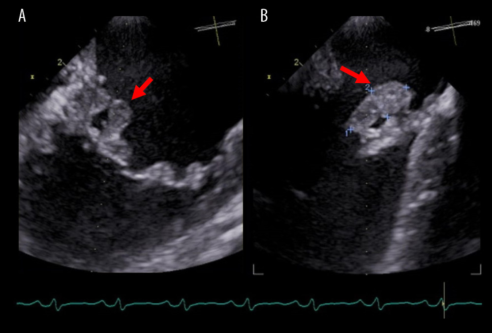 (A, B) Transesophageal echocardiography. A mass (15×7 mm) was attached to the posterior commissure of the mitral valve and medial site of the posterior mitral leaflet. Arrows show the vegetation.