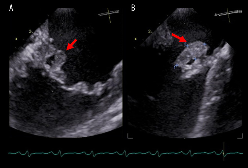 (A, B) Transesophageal echocardiography. A mass (15×7 mm) was attached to the posterior commissure of the mitral valve and medial site of the posterior mitral leaflet. Arrows show the vegetation.