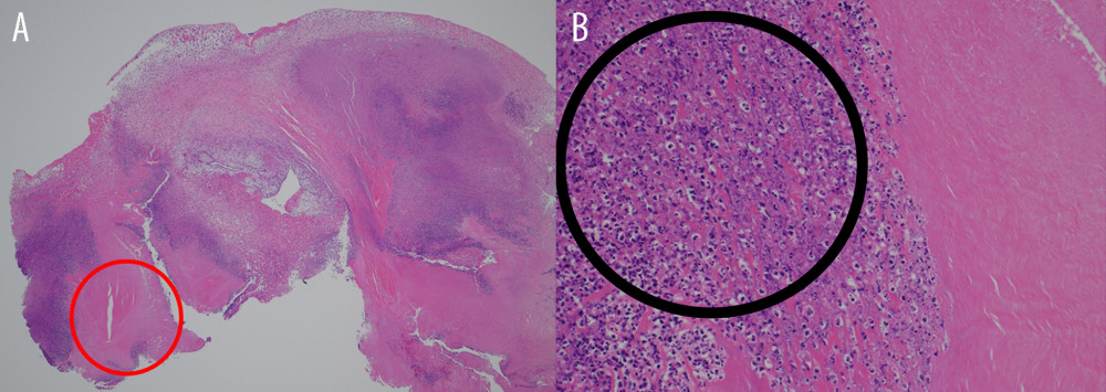 Imaging of hematoxylin and eosin staining of the mitral valve. A large number of neutrophils were found in pathological tissue of the mitral valve, a finding consistent with the development of infective endocarditis. (A) General view of the specimen. (B) The black circle shows the focused image of the inside of the red circle: neutrophils and crushed image of neutrophil nuclei.