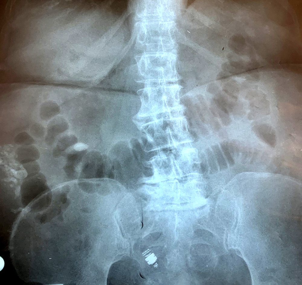 Plain abdominal radiography demonstrates a radiopaque lesion resembling endoscopic capsule in the lower abdomen.