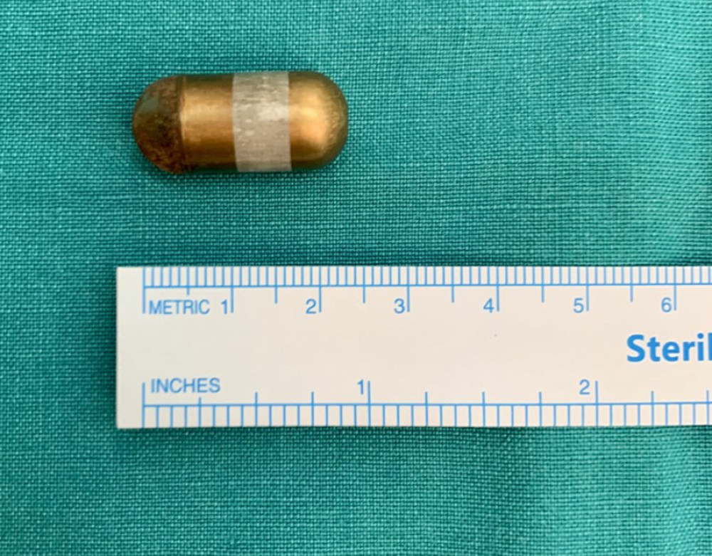 Endoscopic capsule surgically retrieved.
