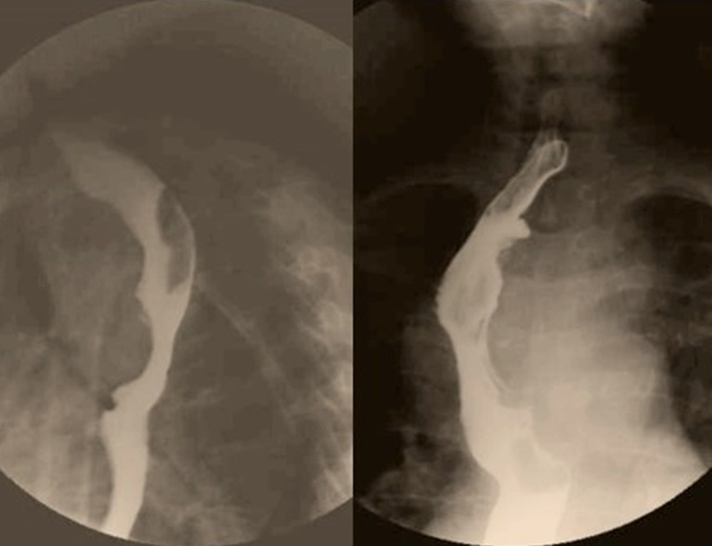 Large smoothly marginated lesion with underlying normal mucosa involving the upper esophagus. It is forming an obtuse angle with an adjacent esophageal wall.