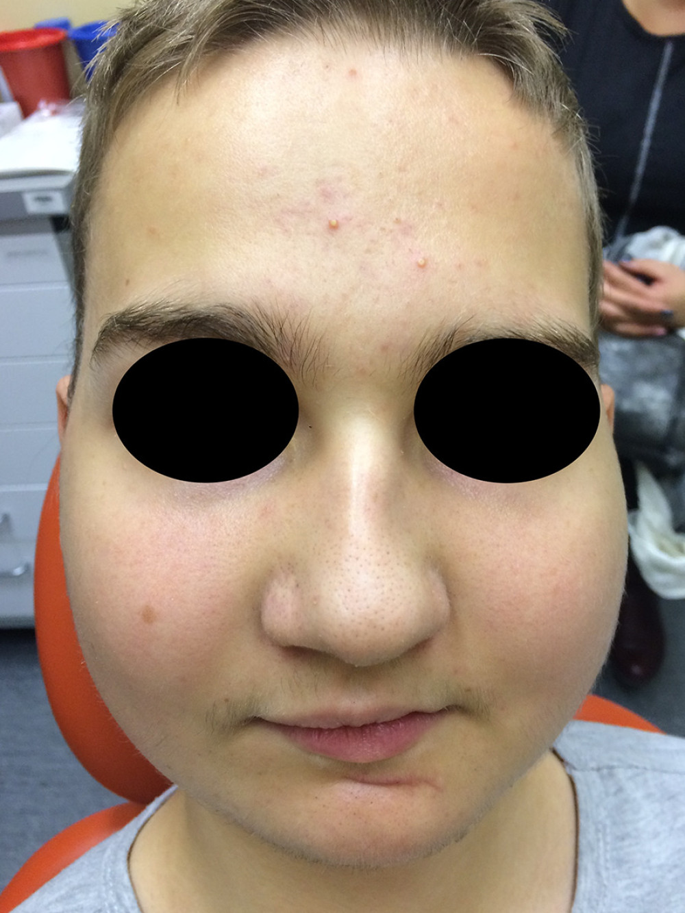 Clinical status of the patient 6 days after surgery. The external clinical examination shows bilateral swelling of the soft tissues of the cheeks and parotideomasseteric regions.