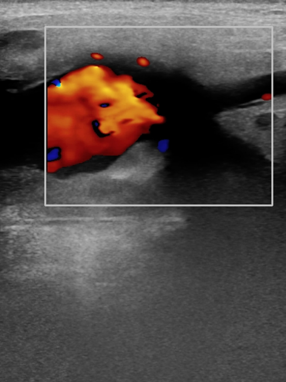 Ultrasonography of the left salivary gland showing aneurysmal dilatation of the left maxillary artery with turbulent flow of blood inside.