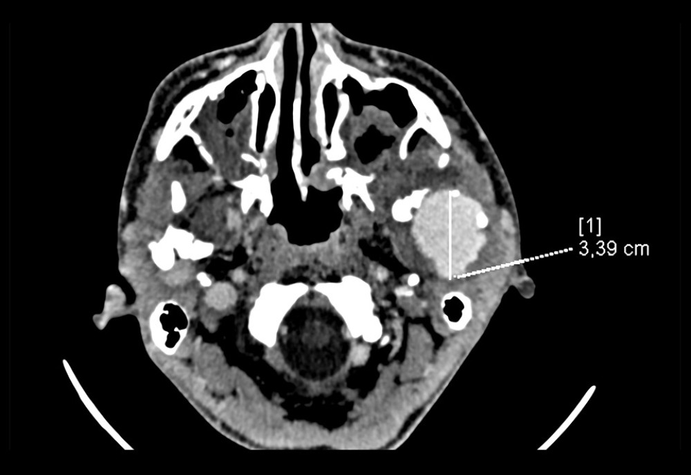 Angio-computed tomography (axial scan) image, freshly extravasated with contrast agent hematoma and clot, and delaminated soft tissues around the hematoma on the left side. The marked line shows the largest dimension of the hematoma. The hematoma is adherent to the fractured and displaced left head of the mandible.