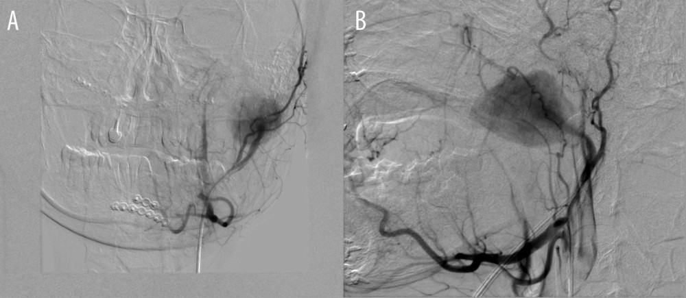 (A, B) Arteriography visualizes contrasted aneurysmal dilatation (pseudoaneurysm) of the left maxillary artery and the afferent left maxillary artery. Remaining extracerebral branches are deprived of any visible vascular malformations.