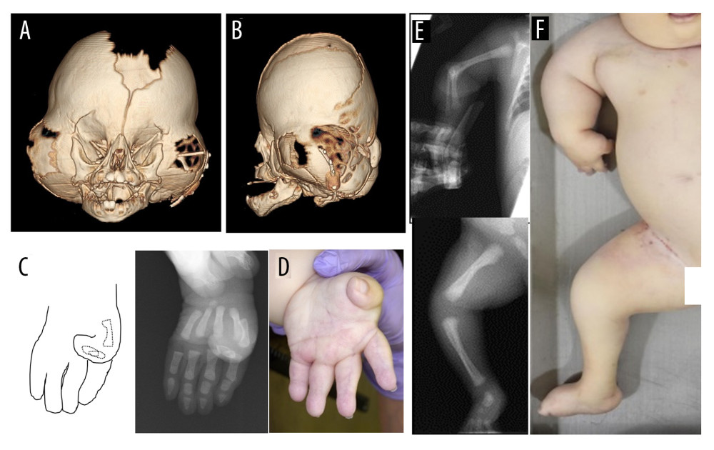 (A) Frontal and (B) lateral 3-dimensional (3D) volume-rendered computed tomography (CT) images of the skull show a cloverleaf configuration with fused bilateral coronal sutures, and a hypoplastic maxilla, which appears relatively small compared with the mandible. (C, D) The thumbs are medially deviated (schema of right hand; dashed lines=thumb bones). (E, F) Metaphyses of the long bones are not yet closed. Micromelia and ankyloses of the elbows are noted.([A, B] 3D volume-rendered CT at 5 months; [C, E] radiographs at birth; [D, F] photographs at autopsy.)