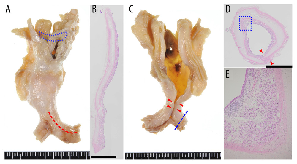 (A) Tracheal cartilage rings fused with each other to form a sleeve of tracheal cartilage. The middle region of hyoid bone is absent (blue dashed line, anterior view of the tracheal cartilage sleeve [TCS]). (B) No tracheal ligaments are present (vertical section of bronchus: red dashed line in a; hematoxylin and eosin staining (H&E), scale bar=5 mm). (C) The posterior membranous septum is narrow (red arrowheads) (posterior view of the TCS). (D) Narrowing of the posterior membranous septum is also identified in the cross-section of the tracheal cartilage. Red arrowheads indicate the posterior membranous septum (cross-section of bronchus: blue dashed line in C; H&E, scale bar=5 mm). (E) Chronic inflammation and hyperplasia of bronchial glands are seen (H&E, ×40: blue dashed line in D).