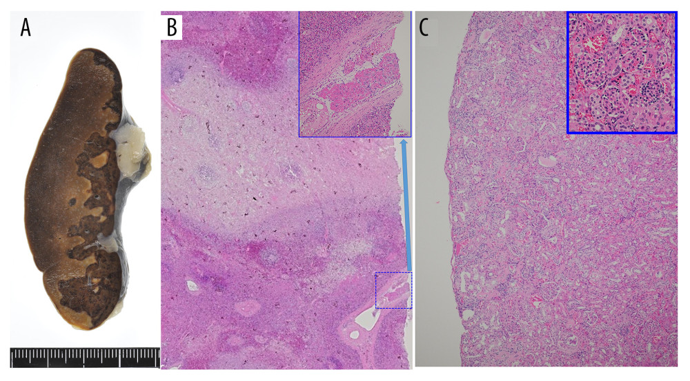 (A) Geographically fused infarct is found in the spleen. (B) The splenic infarction (hematoxylin and eosin staining [H&E], ×40, inset: organized thrombus). (C) Renal cortex (H&E, ×100, inset: immature glomeruli).