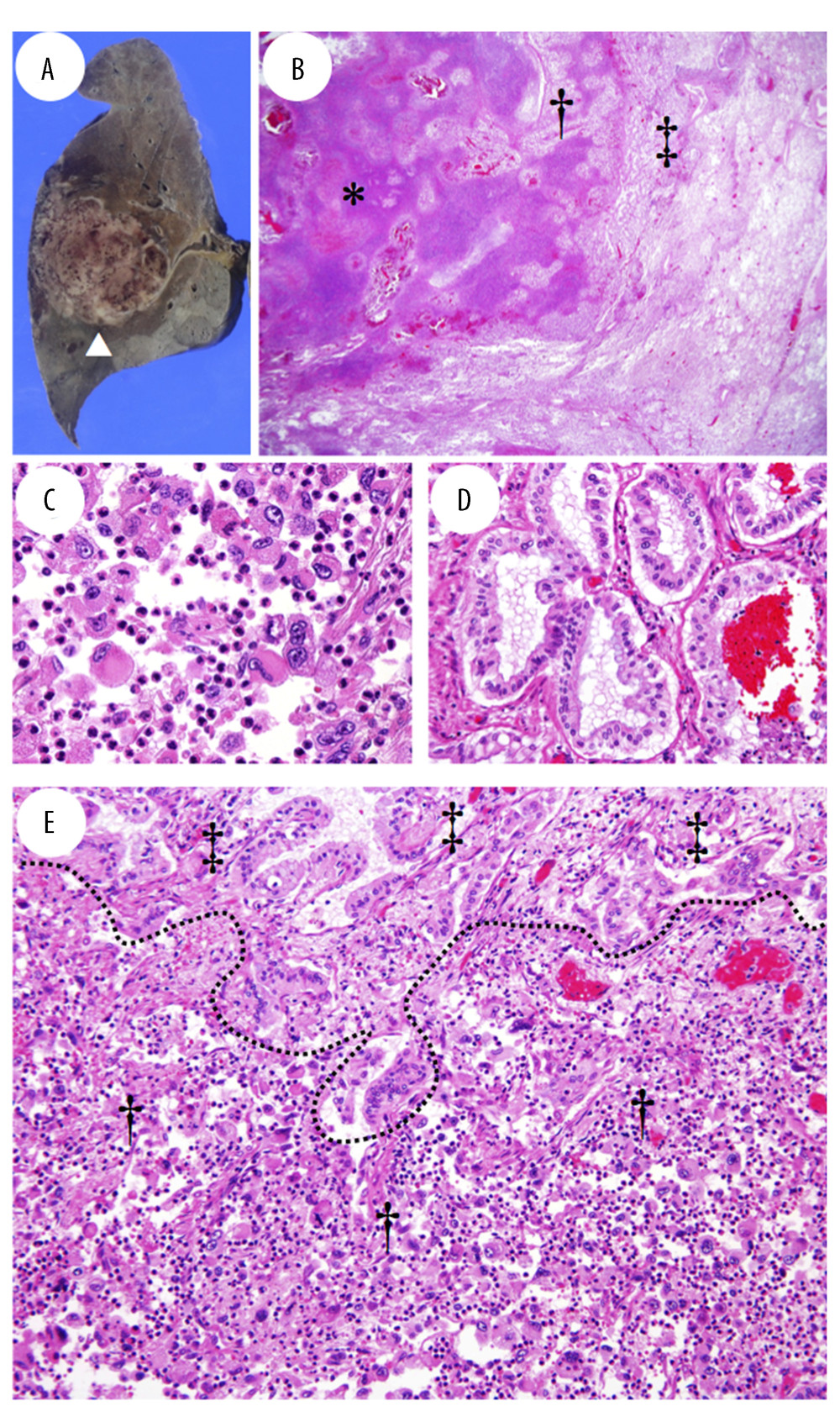 Autopsy findings of the right lower lobe of the lung. (A) Gross appearance. The tumor was well- to partly ill-demarcated and irregularly shaped with massive hemorrhage (arrowhead). (B–E) Histological examination of the right S6 mass specimens revealed an extensive necrotic area (* in B) with a component of the solid area with rhabdoid cells, characterized by large cells with eccentrically located nuclei, prominent nucleoli, abundant eosinophilic cytoplasm, and large paranuclear intracytoplasmic inclusions († in B, C). The tumor also had a component of non-mucinous adenocarcinoma with focal intracytoplasmic mucin (‡ in B, D). (E) A continuum of changes from adenocarcinoma (‡) to the solid area with rhabdoid cells (†). B: 15×; C: 400×; D, E: 200× magnification. Hematoxylin and eosin (H&E) stain.