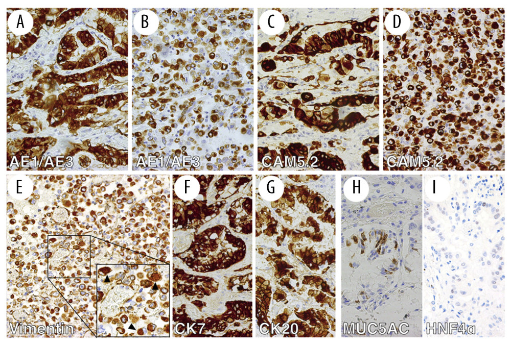 Immunohistochemical findings of the tumor in the right lobe of the lung. The adenocarcinoma component was positive for AE1/AE3 (A), CAM 5.2 (C), CK7 (F), and CK20 (G). Little immunopositivity for MUC5AC (H) and HNF4α (I) was observed in the adenocarcinoma lesion. The component of rhabdoid cells was positive for AE1/AE3 (B), CAM 5.2 (D), and vimentin (E). Paranuclear intracytoplasmic inclusions were strongly positive for vimentin in some of the rhabdoid cells (E, arrowheads). A–I: 200× magn.