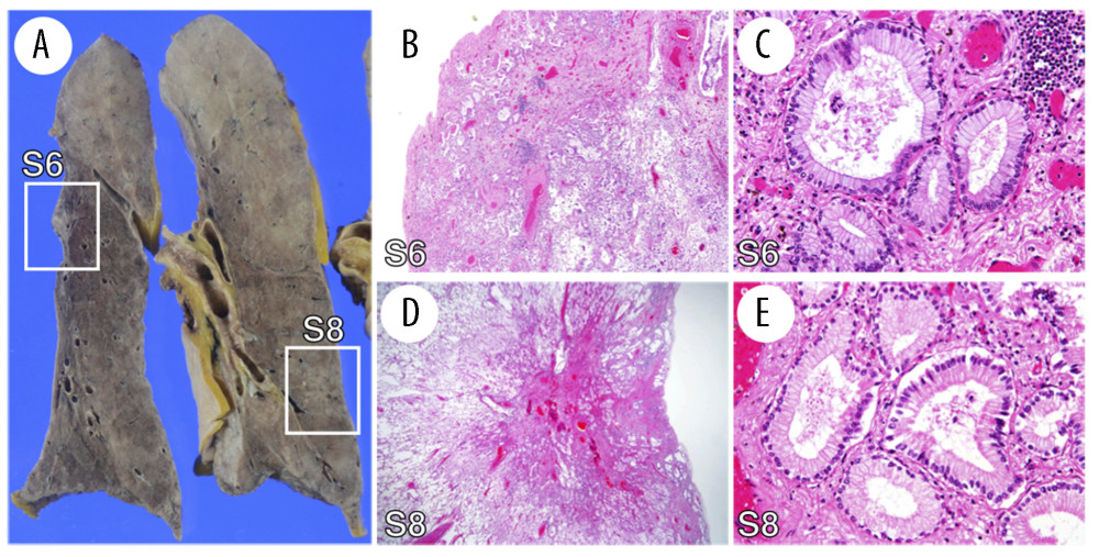 Autopsy findings of the left lower lobe of the lung. A: Gross appearance. The tumors located in the left S6 and left S8 segments are shown. Histological examination of the nodules in the left S6 (B, C) and left S8 (D, E) segments revealed adenocarcinoma lesion with focal intracytoplasmic mucin. B: 40×; C, E: 400×; D: 12.5× magn. H&E stain.