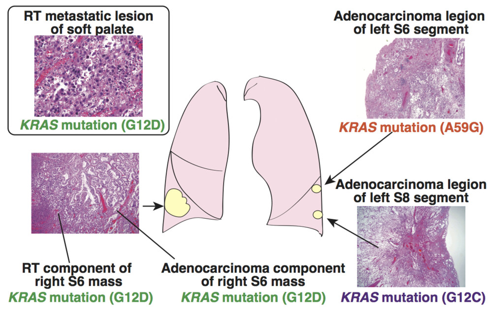 KRAS mutational analyses. The same KRAS mutation (G12D) was detected in both components of the rhabdoid tumor and the adenocarcinoma in the tumor of the right S6 segment as well as a metastatic rhabdoid tumor in the soft palate. The adenocarcinomas in the left S6 and left S8 segments possessed different types of KRAS mutation, i.e., A59G and G12C, respectively.