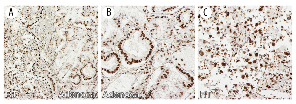 Immunohistochemical findings of SMARCA4 (BRG1, A–C). Both adenocarcinoma cells (B) and rhabdoid tumor cells (C) retained nuclear expression of SMARCA4. A: 100×; B, C: 200× magn.