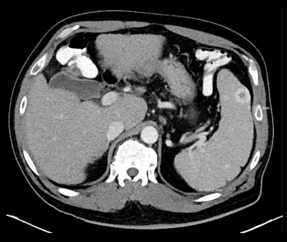 CT Abdomen and pelvis demonstrating cirrhotic morphology of the liver, splenomegaly, and splenic lesions.