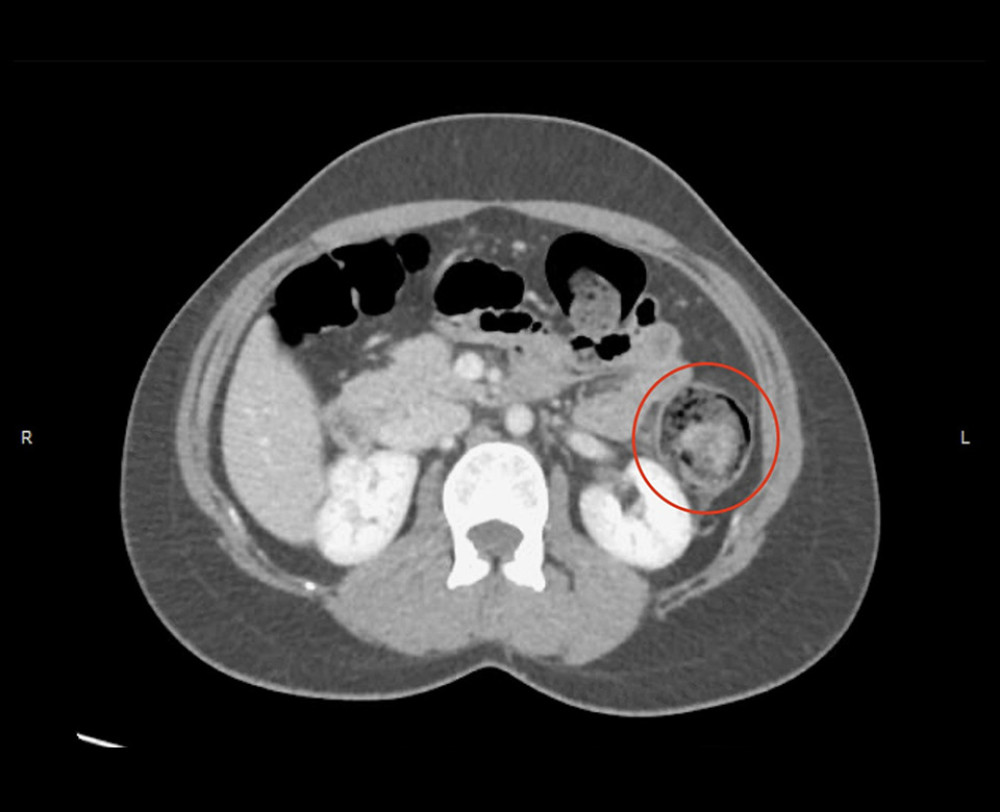 Computed tomography (CT) scan oriented on an axial plane demonstrating a 6 cm in length intussuscepted colon, highlighted by the red circle.