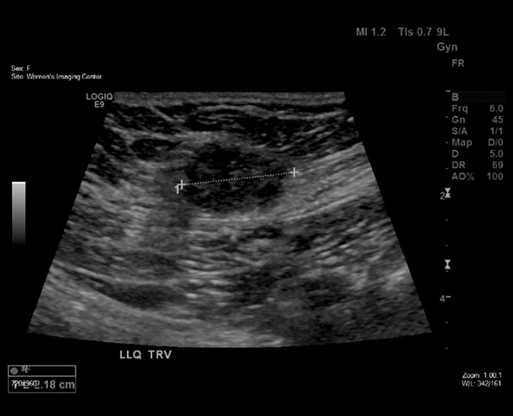 The transabdominal imaging pelvic ultrasound showing an irregular hypoechoic solid mass of 2×1.3×2.2 cm, partially projecting into the subcutaneous tissues.