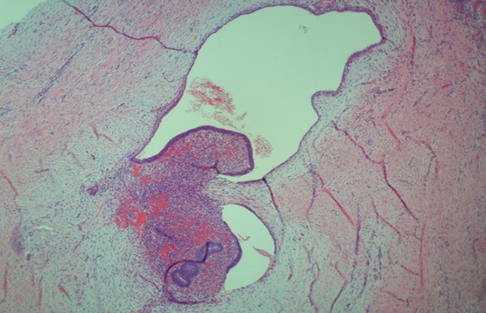 Hematoxylin and eosin photomicrograph ×20 magnification showed tissue surrounding benign endometrial glands and stroma consistent with endometriosis, showing hemorrhage at the center of the cystic space.