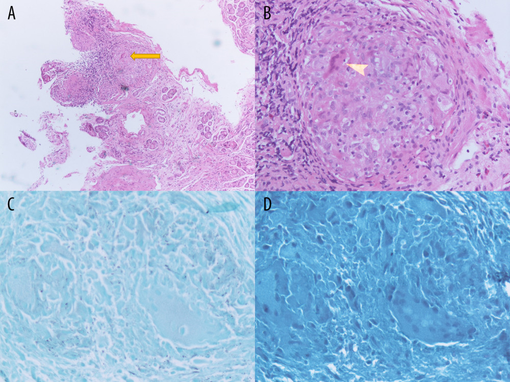Gastrointestinal sarcoidosis. Histopathology of the upper-endoscopic gastric antrum biopsies with H&E staining revealing non-caseating epithelioid cell granulomas (arrow heads) without dysplasia or metaplasia at low power (A) and high power (B). GMS (C) and AFB (D) stains negative to rule out fungi and mycobacteria.