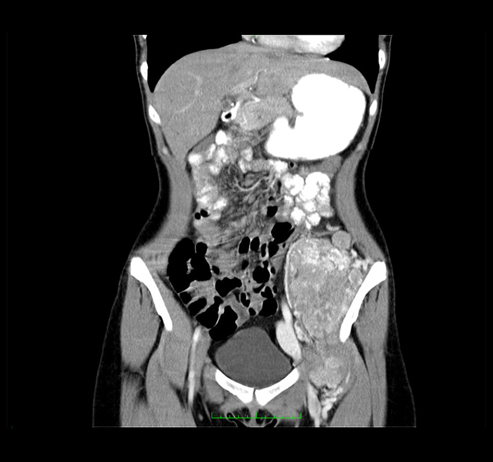 CT scan of primary tumor – 05.2012 (Horos, v 3.3.5).