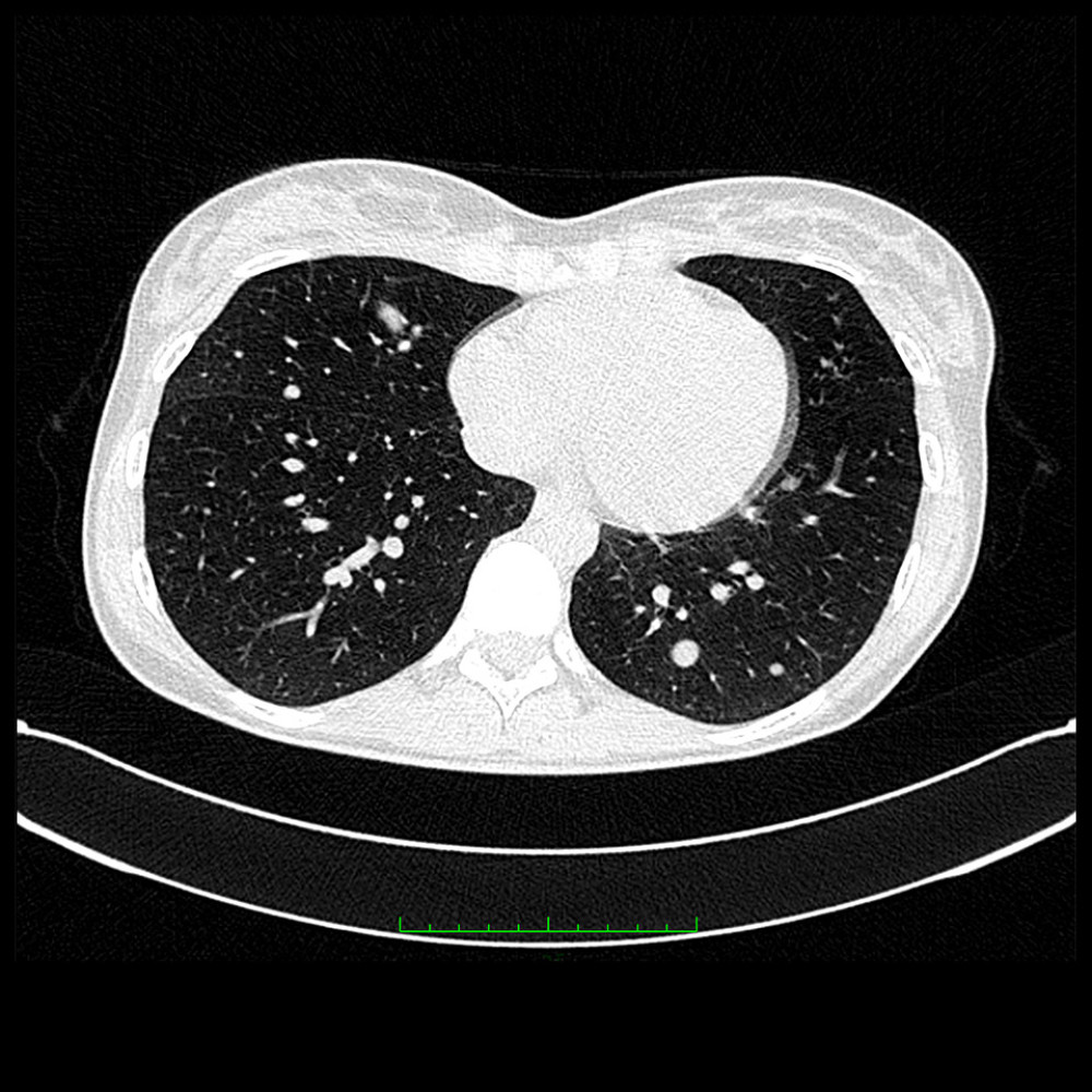 CT scan of pulmonary metastases – 05.2012 (Horos, v 3.3.5).