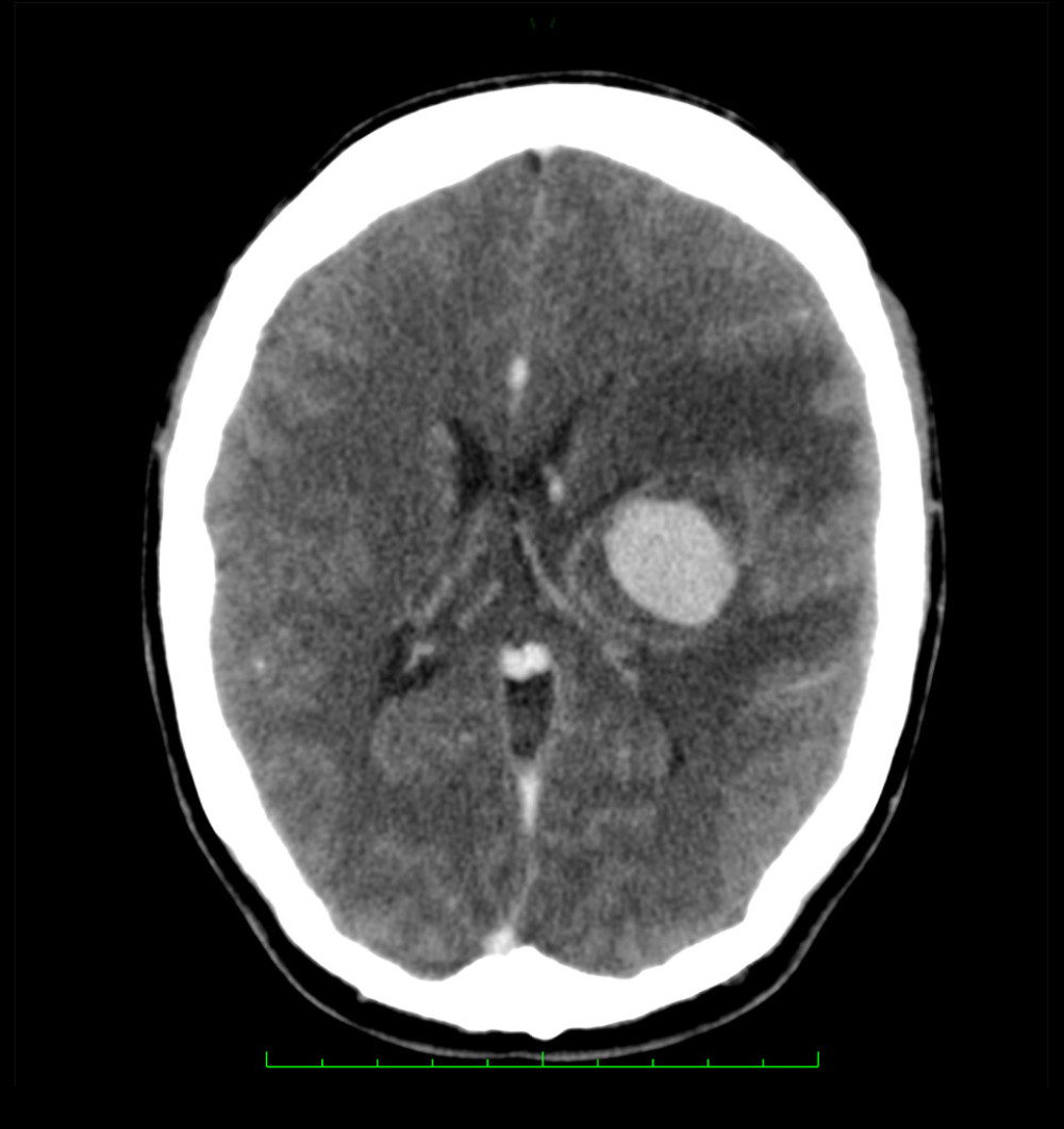 CT scan of brain metastasis – 05.2013 (Horos, v 3.3.5).