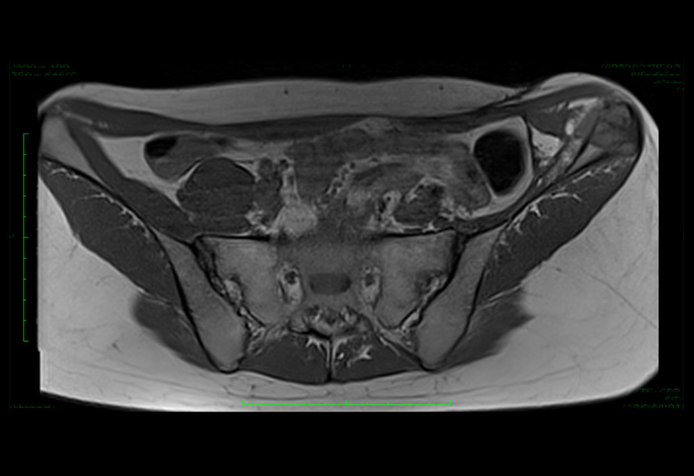 MRI T1 image of metastasis in left iliac bone – 05.2015 (Horos, v 3.3.5).