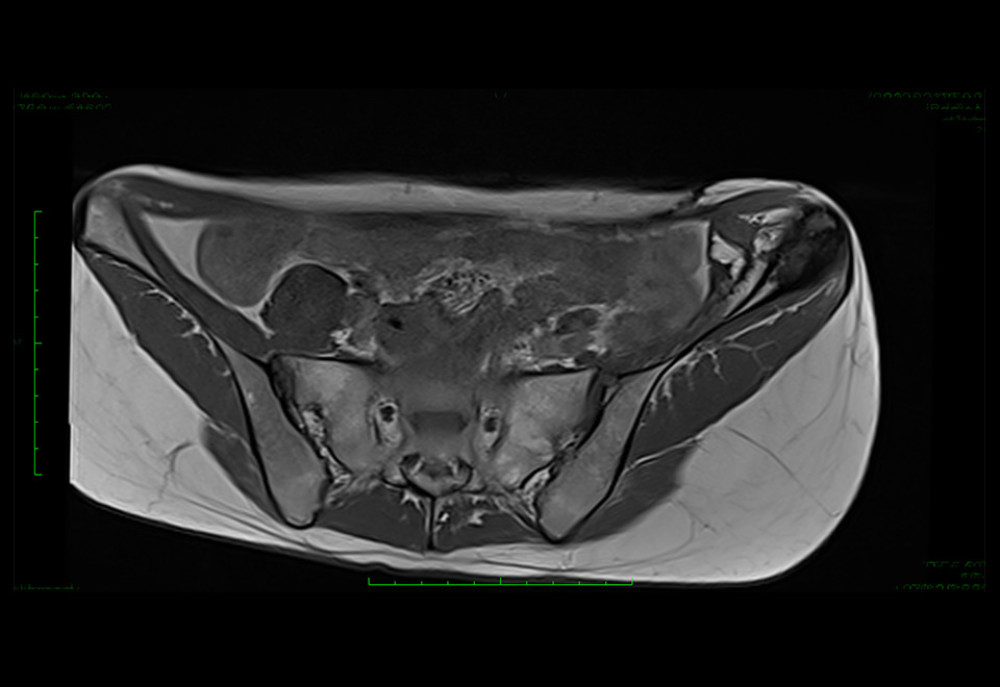 MRI T1 image of metastasis in left iliac bone – 02.2021 (Horos, v 3.3.5).