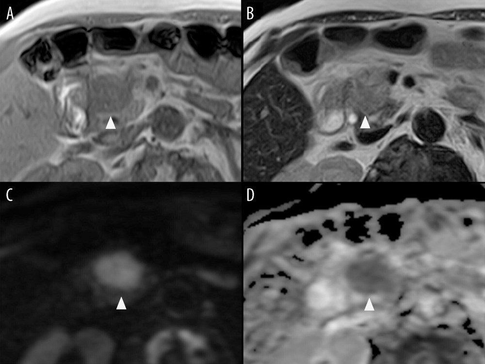 Magnetic resonance imaging (pancreatic head). A mass lesion in the pancreatic head showed low signal intensity on both T1- (A) and T2-weighted images (B) and a decrease in apparent diffusion coefficient values on diffusion-weighted image (C, D, arrowhead).