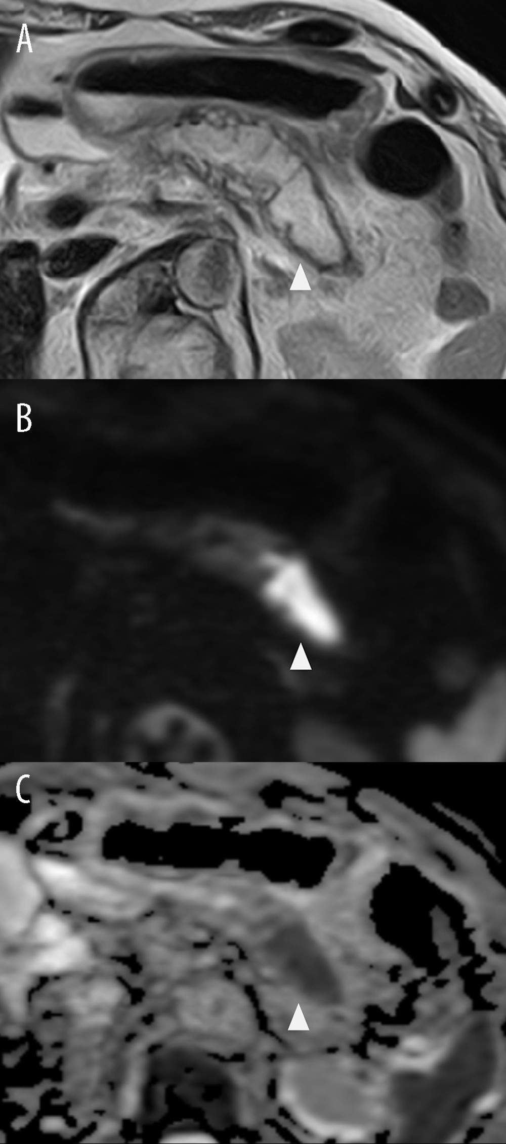Magnetic resonance imaging (pancreatic body and tail). The main pancreatic duct (MPD) dilation with a maximum diameter of 16 mm in the pancreatic body and tail was detected on (A) T2-wighted image, and the inside of the delated MPD in the pancreatic tail showed a decrease in apparent diffusion coefficient values on diffusion-weighted image (B, C, arrowhead).