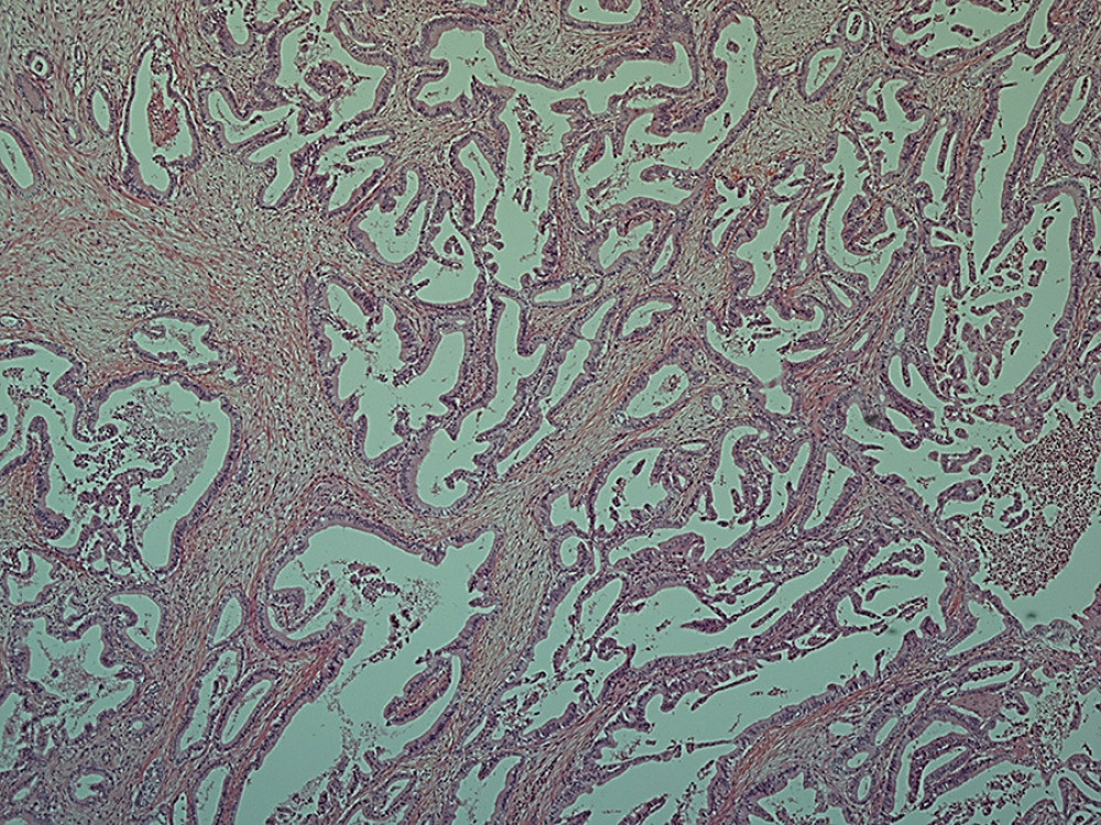 Histological findings of the resected specimens (pancreatic head). A well-differentiated tubular adenocarcinoma occupied the pancreatic head (hematoxylin and eosin staining, orig. mag., ×40).