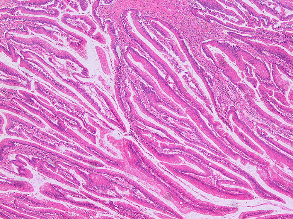 Histological findings of the resected specimens (pancreatic body and tail). The inside of the main pancreatic duct was packed with atypical papillary epithelium in the pancreatic body and tail (hematoxylin and eosin staining, orig. mag., ×40).