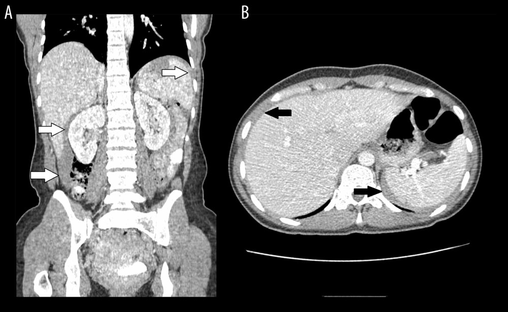 Contrast-enhanced CT at admission. (A) Coronal plane. Hemorrhage fluid located around the spleen and liver (white arrows), in the paracolic gutters (white arrow), and the pelvis. (B) Axial plane. Perisplenic and perihepatic hematoma (black arrows).