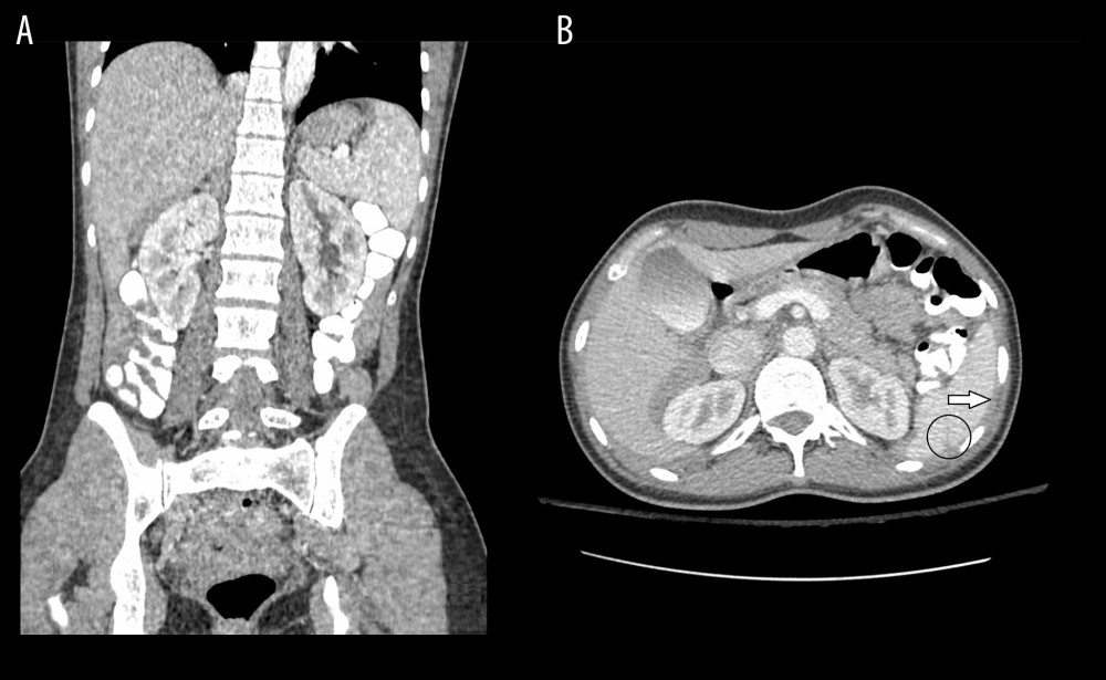 Contrast-enhanced CT 24 h after admission. (A) Coronal plane. Gradual decrease of the perisplenic and perihepatic hematoma. (B) Axial plane. A small rupture of the posterior surface of the lower pole of the spleen (black circle) is shown accompanied by perisplenic hematoma (white arrow).
