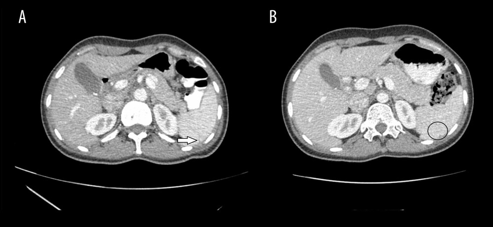 Contrast-enhanced CT, axial plane. (A) On the 6th day of admission. The rupture of the spleen (white arrow) and the decreasing size of the perisplenic and perihepatic hematoma are shown. (B) Follow-up 1 month after the admission. Complete healing of the splenic rupture, with no presence of intraperitoneal fluid (black circle).