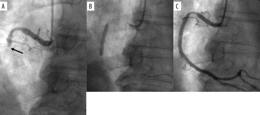 Emergency coronary angioplasty. Coronary angiography shows total occlusion in the middle portion of the right coronary artery (A, arrow). After thrombus aspiration, stent implantation (B) was successfully performed, without residual stenosis (C).