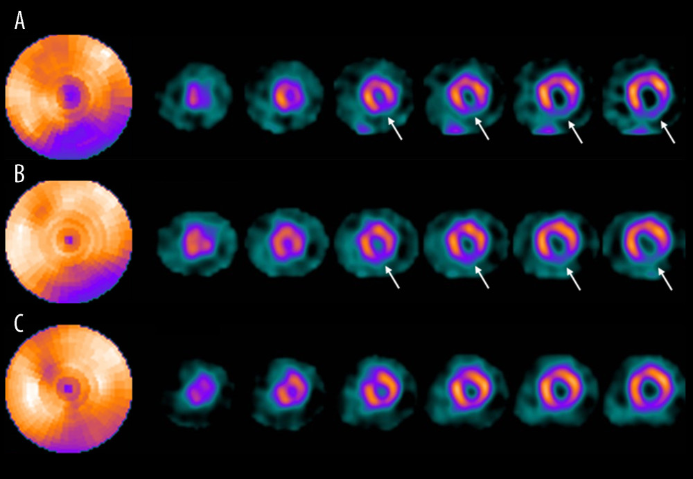 Serial changes in thallium-201 scintigraphic findings. Bull’s-eye maps and short-axis images show severely reduced uptake of tracer in the inferior wall 4 h after the onset of ST-segment elevation (A, arrows), partial redistribution 24 h later (B, arrows), and increased accumulation 4 months later (C).