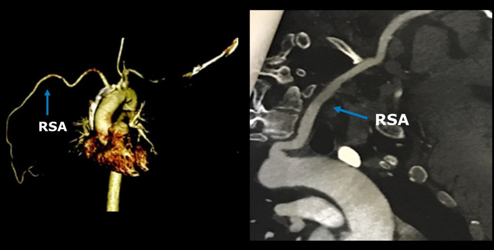 The right subclavian artery (RSA) is retroesophageal, but the clinical significance of this finding is unknown.
