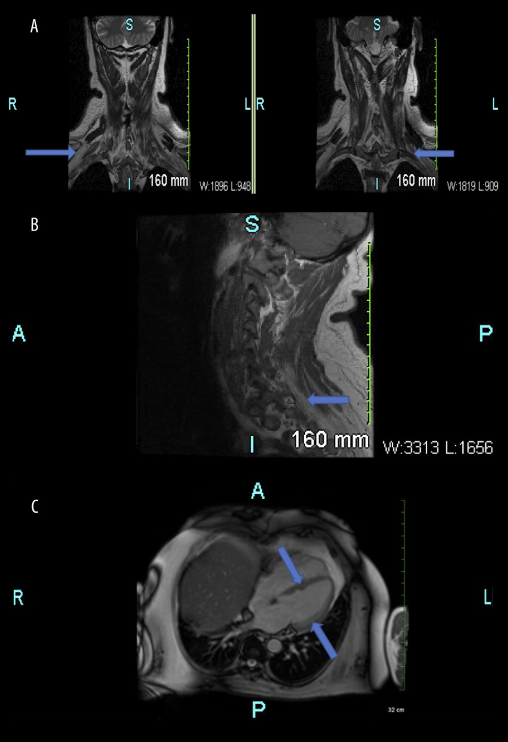 (A) Coronal T2 section showing fibrofatty infiltration of proximal muscles (arrows). (B) Sagittal T2 section showing fibrofatty changes in the paraspinal muscles (arrow). (C) Cross sectional T2 image showing biventricular dilation with fibrosis in the basal septum and inferolateral wall (arrows) of the heart.