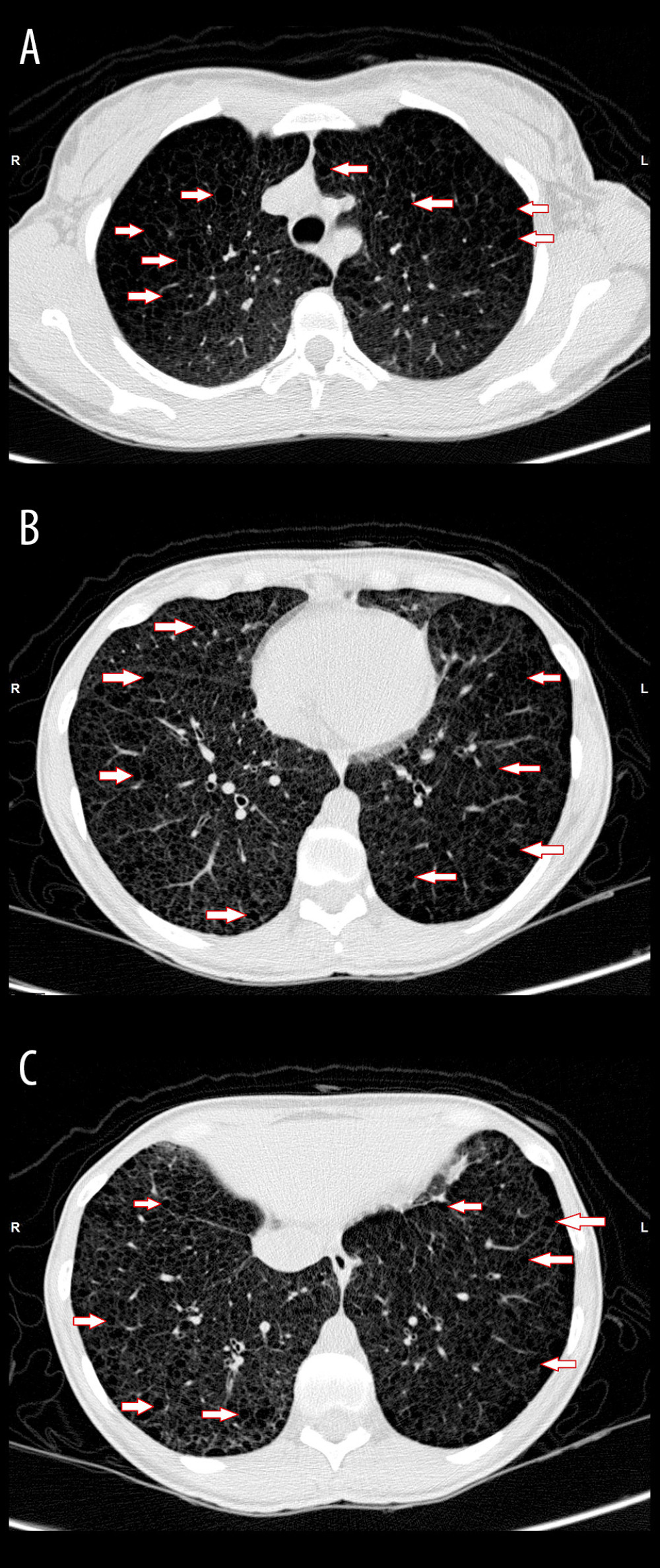 Chest computed tomography images of the patient when the diagnosis of pulmonary lymphangioleiomyomatosis was made. (A) The superior lobes show diffuse, rounded, bilateral, and thin-walled cysts of varying sizes (arrows). (B) The average portion of the lungs shows diffuse, rounded, bilateral, and thin-walled cysts (arrows). (C) The lower lobes show diffuse, rounded, bilateral and thin-walled cysts (arrows).