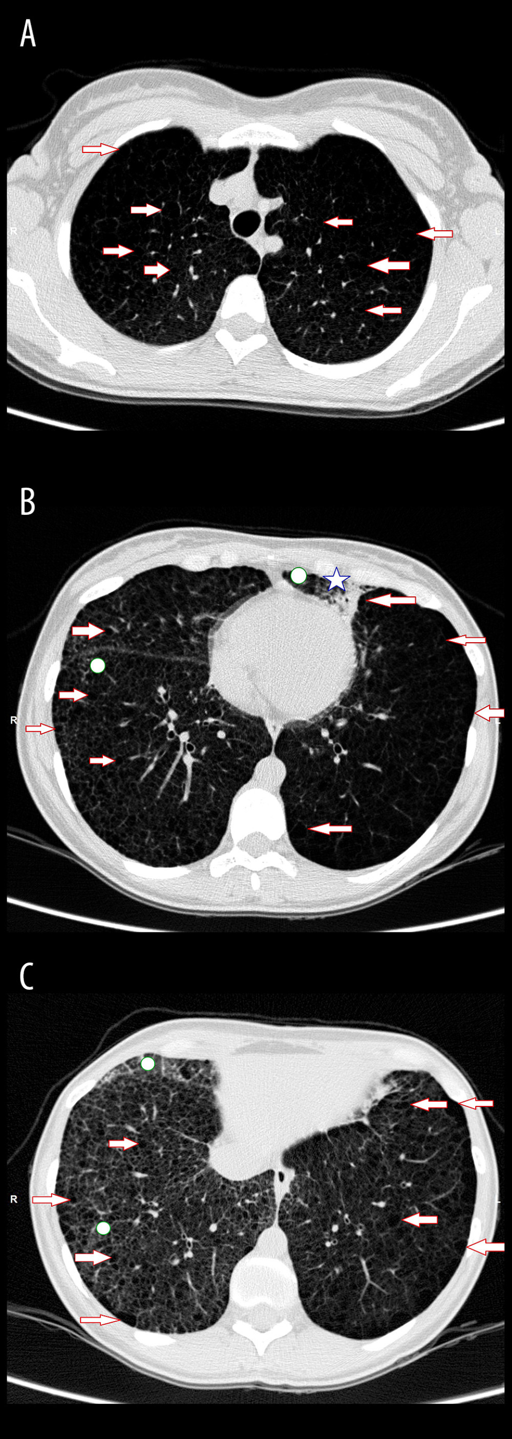 Chest computed tomography images of the patient when she had COVID-19 pneumonia 5 months after the diagnosis of pulmonary lymphangioleiomyomatosis (A) The superior lobes show diffuse, rounded, bilateral and thin-walled cysts of varying sizes (arrows). (B) The average portion of the lungs shows diffuse, rounded, bilateral cysts (arrows), foci of consolidation in lingular segment (star), and ground-glass opacities (circles). (C) The inferior lobes show diffuse, rounded, bilateral cysts (arrows) and ground-glass opacities (circles).