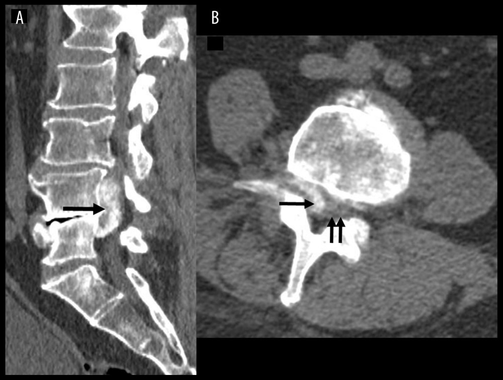 Non-contrast computed tomography scan sagittal (A) and axial (B) views showing a heterogeneous calcified epidural mass (arrow in A) compressing and displacing posterolateraly the dural sac (arrows in B).