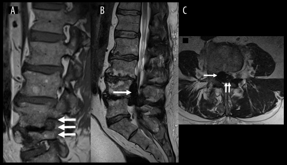 Magnetic resonance imaging in T1-weighted sagittal (A) and T2-weighted sagittal (B) and axial (C) images showing a heterogeneous hypointense epidural mass (arrow) compressing and displacing posterolateraly the dural sac (double arrow), and causing right foraminal stenosis at the L4–L5 level (triple arrow). As a consequence, the descending and emerging roots were compromised.