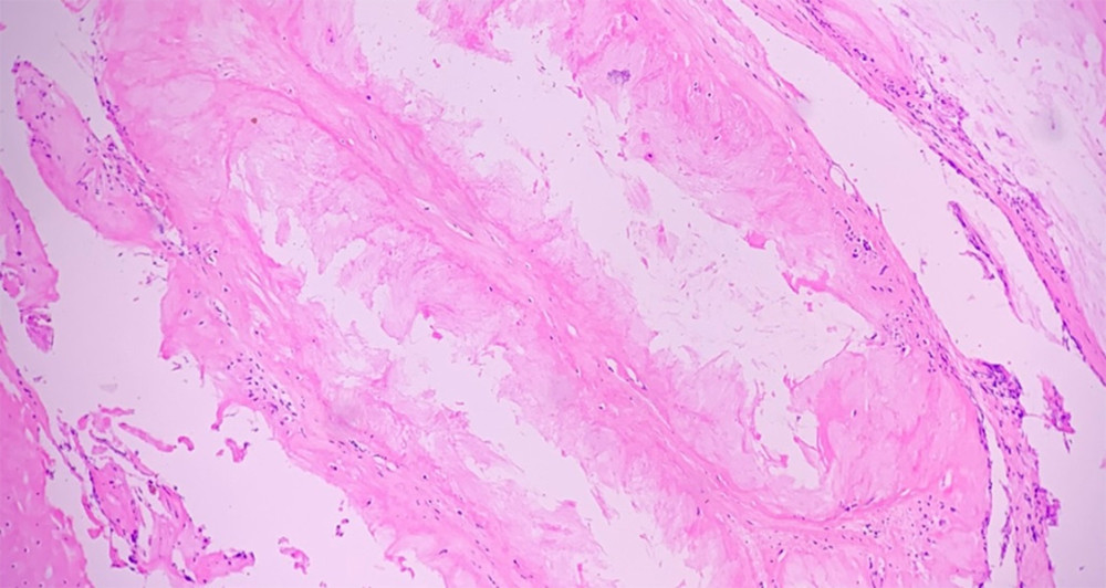 Histopathology section of spine mass showing a thin layer of mononuclear inflammatory infiltrate with giant cells surrounding the amorphous crystalline material, typical of gout tophi. Hematoxylin-eosin staining, ×100.