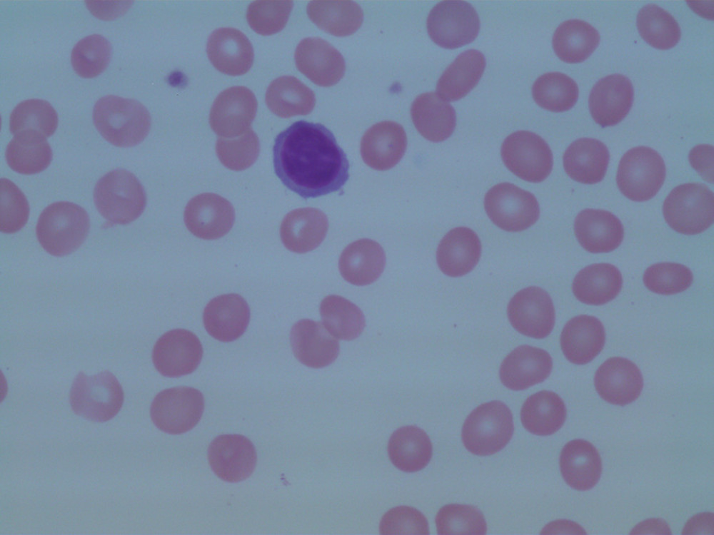 Morphological features of circulating lymphocytes. Polar villi were not apparent in this case.